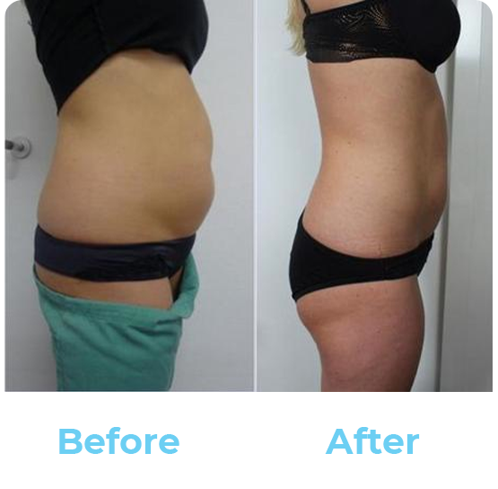 Cryotherapy Results